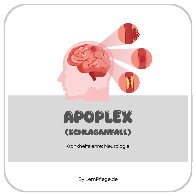 Schlaganfall (Apoplex)